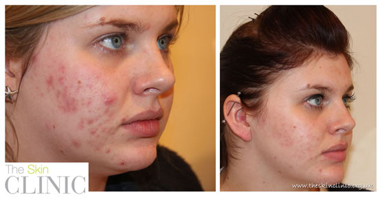 Results for treating acne with Lustre Pure Light blue therapy